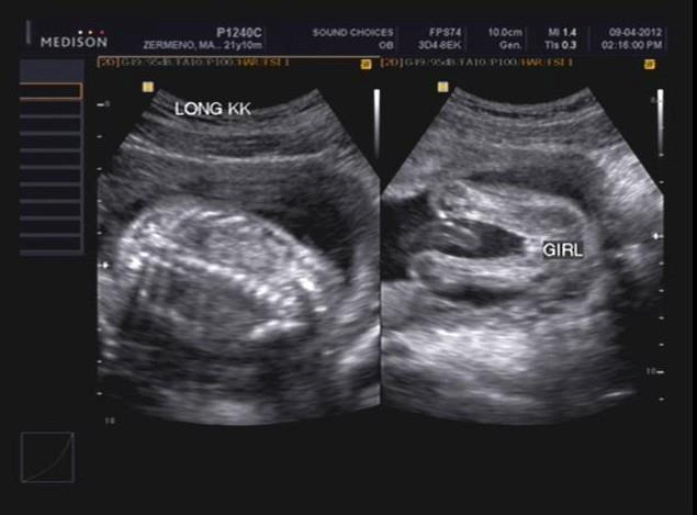 porn ultrasound - katie kox sophie dee 800 balas where to watch